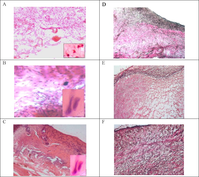 Sodium carboxymethylcellulose scaffolds and their physicochemical effects on partial thickness wound 